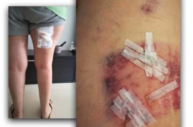 Heridas del ataque de un jabalí a una mujer
