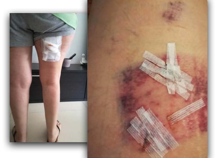 Heridas del ataque de un jabalí a una mujer